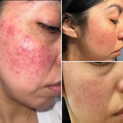 Sulfur Cream No Tea Tree Acne Malassezia