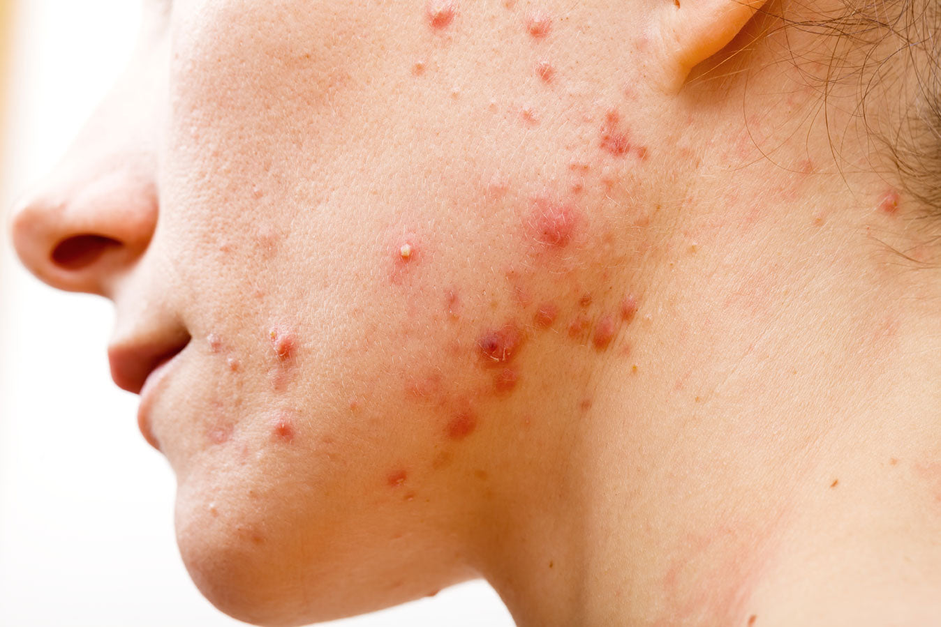 Malassezia Foliculitis and Yeast skin problems