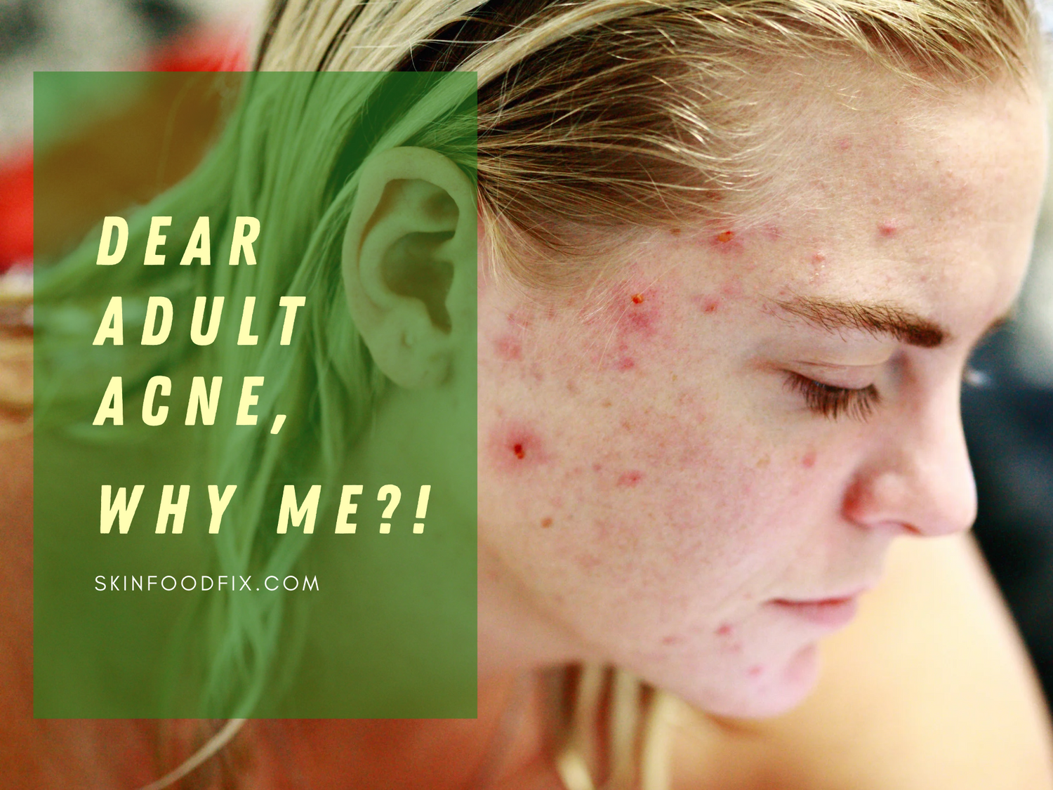 Dear Adult Acne, Why Me?!