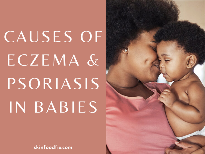 Babies Children Eczema and or Psoriasis?