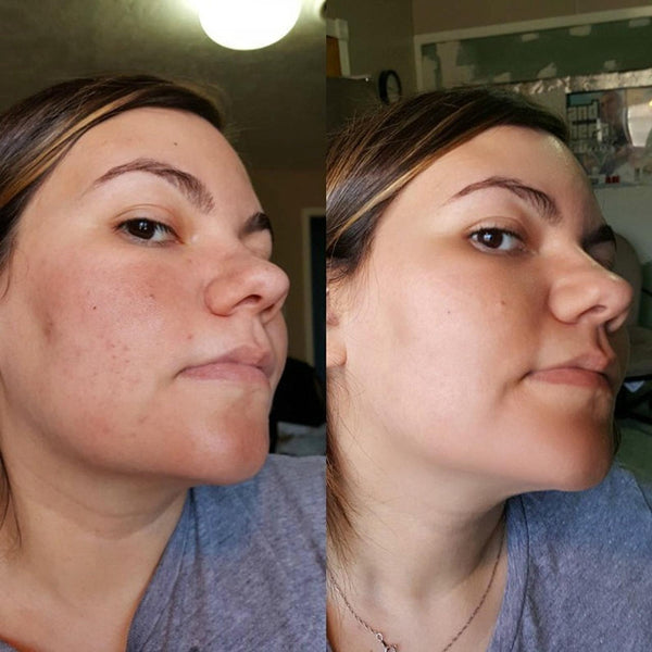 MSM, the Anti-Aging and Rosacea Hero You Didn't Know You Needed