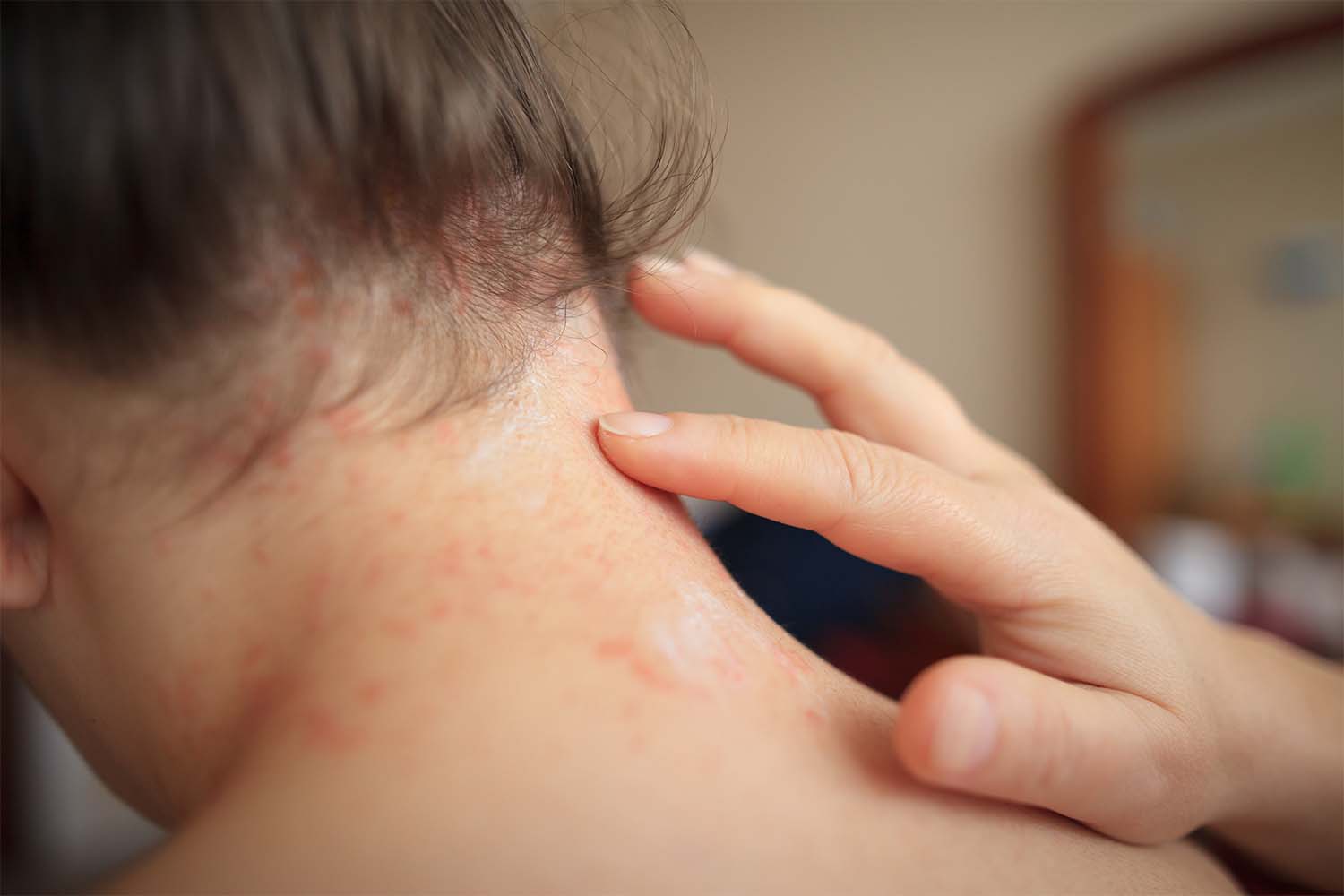 Understanding Seborrheic Dermatitis: Symptoms, Causes, and Treatments