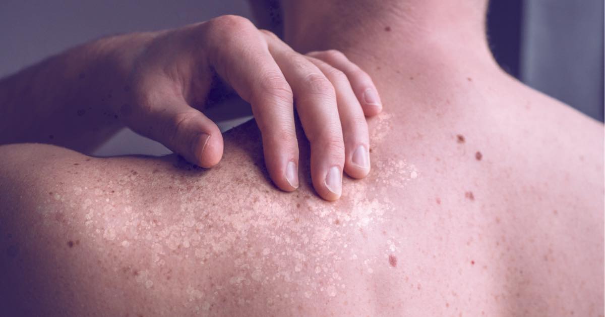 Tinea Versicolor: What It Is and Natural Remedies for Healing