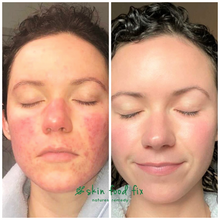 Load image into Gallery viewer, Rosacea Skin Redness &amp; Irritation Set